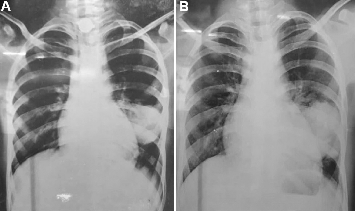 Chest radiograph in postero-anterior projection showing homogenous rounded opacity in left lower zone. (A) Image taken in 2016 and (B) Image taken at presentation in 2019. The opacity persisted over a gap of three years with slight increase in size.